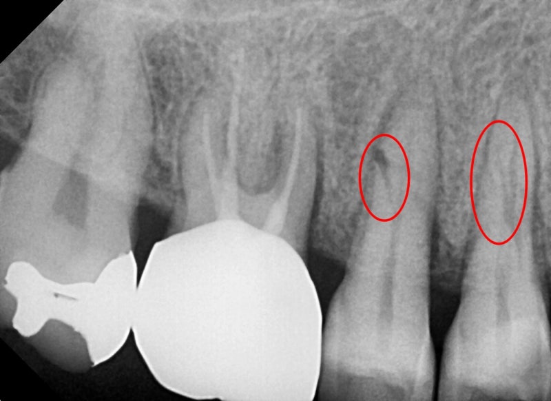 Yaksu Implant: What Causes Sudden Pain When Chewing? 사진 2