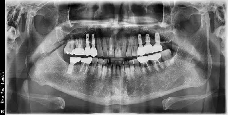 Yaksu Implant: What Causes Sudden Pain When Chewing? 사진 6