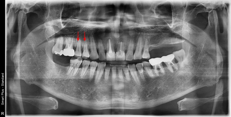 Yaksu Implant: What Causes Sudden Pain When Chewing?
