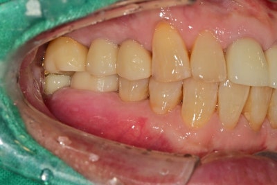 Yaksu Implant: What Causes Sudden Pain When Chewing? 사진 7