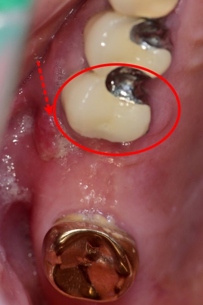 Singeumho Dental Clinic: Problems that Arise in Teeth from Long-Term Denture Use 사진 3