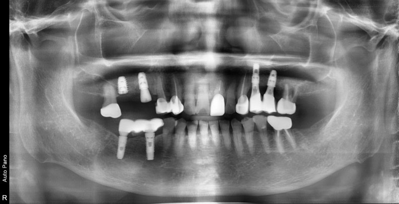 Singeumho Dental Clinic: Problems that Arise in Teeth from Long-Term Denture Use