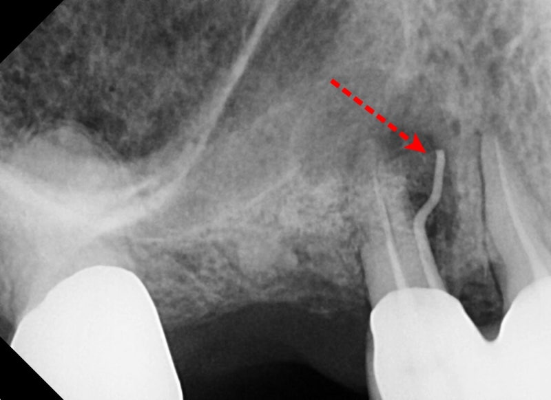 Singeumho Dental Clinic: Problems that Arise in Teeth from Long-Term Denture Use 사진 2