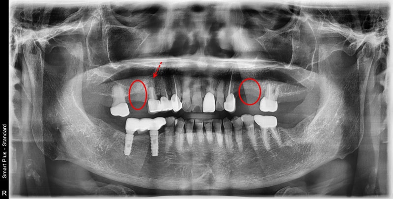 Singeumho Dental Clinic: Problems that Arise in Teeth from Long-Term Denture Use