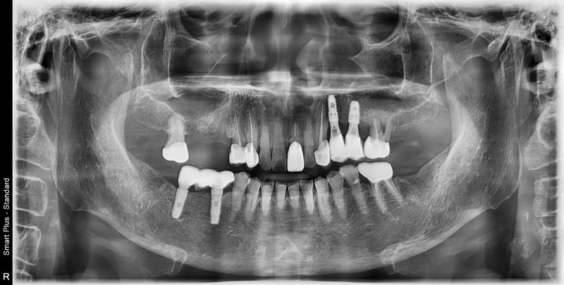 Singeumho Dental Clinic: Problems that Arise in Teeth from Long-Term Denture Use 사진 4