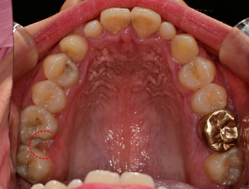 Gum Contouring for Permanent Tooth Treatment at a Dental Clinic Near Nongol Sageori, Geumho-dong 사진 5