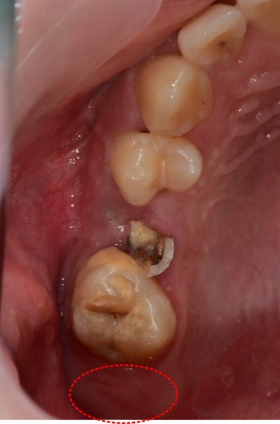 Gum Contouring for Permanent Tooth Treatment at a Dental Clinic Near Nongol Sageori, Geumho-dong 사진 3