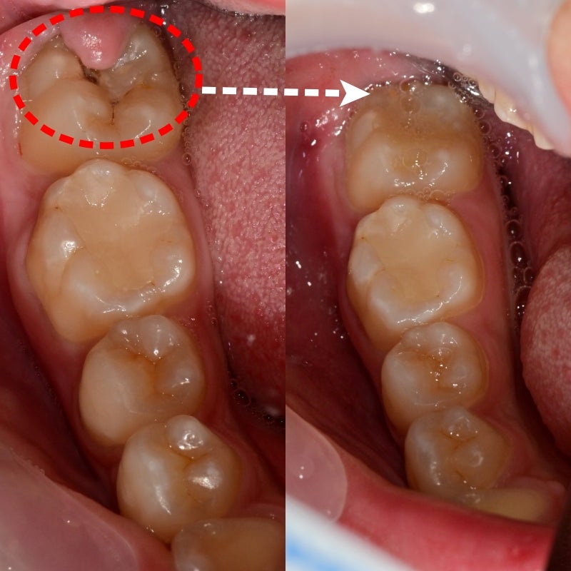 Gum Contouring for Permanent Tooth Treatment at a Dental Clinic Near Nongol Sageori, Geumho-dong