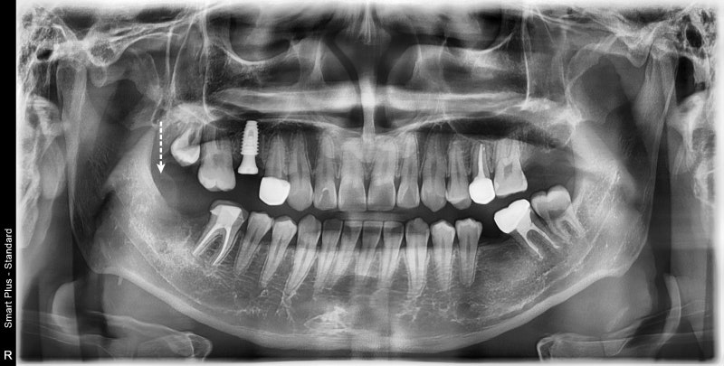 Gum Contouring for Permanent Tooth Treatment at a Dental Clinic Near Nongol Sageori, Geumho-dong 사진 4
