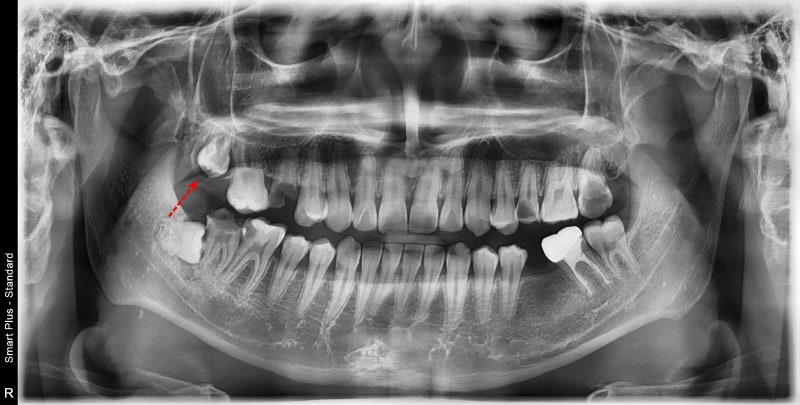 Gum Contouring for Permanent Tooth Treatment at a Dental Clinic Near Nongol Sageori, Geumho-dong