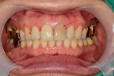 Shindang-dong Discolored Front Tooth Crown Treatment: Bareunyoung Dental Esthetic Prosthesis Case 사진 2