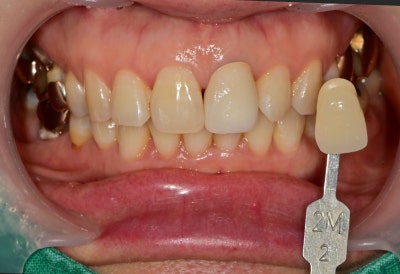 Shindang-dong Discolored Front Tooth Crown Treatment: Bareunyoung Dental Esthetic Prosthesis Case 사진 4