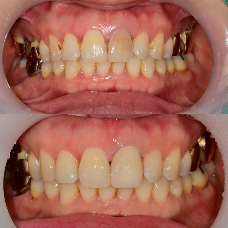 Shindang-dong Discolored Front Tooth Crown Treatment: Bareunyoung Dental Esthetic Prosthesis Case 사진 6