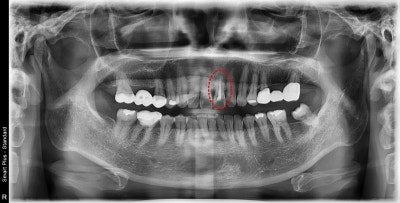Shindang-dong Discolored Front Tooth Crown Treatment: Bareunyoung Dental Esthetic Prosthesis Case