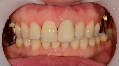 Shindang-dong Discolored Front Tooth Crown Treatment: Bareunyoung Dental Esthetic Prosthesis Case