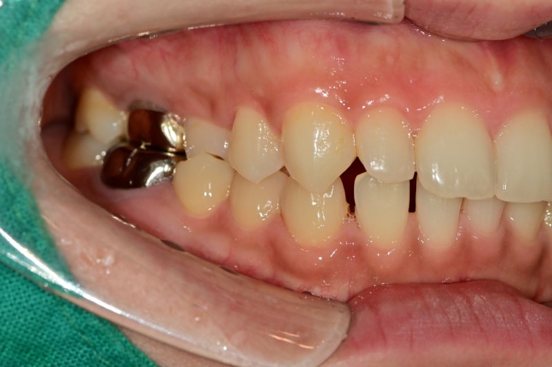 Yaksu Station Dental Clinic: Treatment for Gapped Front Teeth (Diastema) Using Resin 사진 2