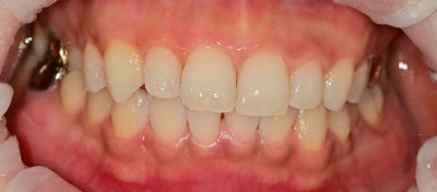 Yaksu Station Dental Clinic: Treatment for Gapped Front Teeth (Diastema) Using Resin 사진 6