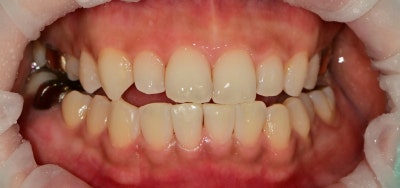 Yaksu Station Dental Clinic: Treatment for Gapped Front Teeth (Diastema) Using Resin 사진 5