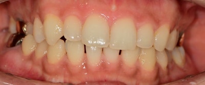 Yaksu Station Dental Clinic: Treatment for Gapped Front Teeth (Diastema) Using Resin 사진 4