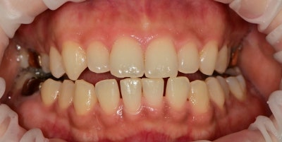 Yaksu Station Dental Clinic: Treatment for Gapped Front Teeth (Diastema) Using Resin