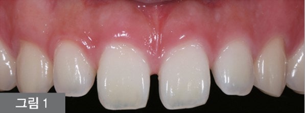 Yaksu Station Dental Clinic: Treatment for Gapped Front Teeth (Diastema) Using Resin