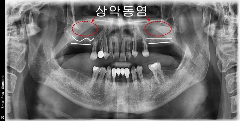 약수역 치과 비염 수술 후 상악동 임플란트 과정