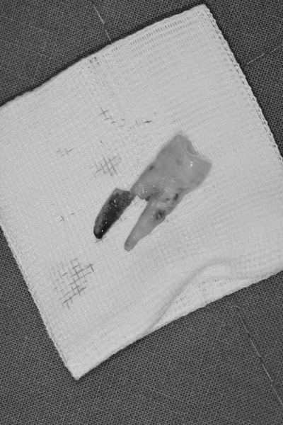 Shindang-dong Dental Clinic: Implant and Tooth Problems When Chewing Causes Pain 사진 4