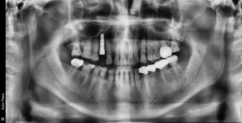 Shindang-dong Dental Clinic: Implant and Tooth Problems When Chewing Causes Pain 사진 6