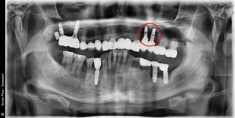 Shindang-dong Dental Clinic: Implant and Tooth Problems When Chewing Causes Pain 사진 7