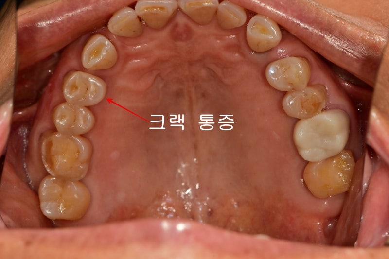Shindang-dong Dental Clinic: Implant and Tooth Problems When Chewing Causes Pain 사진 2