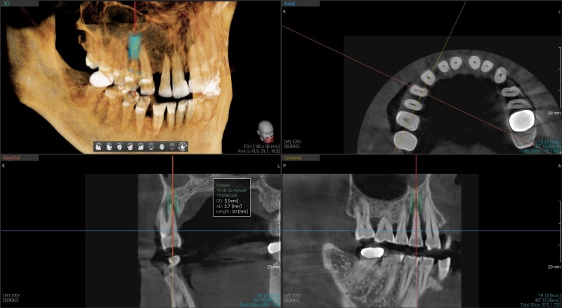 Shindang-dong Dental Clinic: Implant and Tooth Problems When Chewing Causes Pain 사진 3