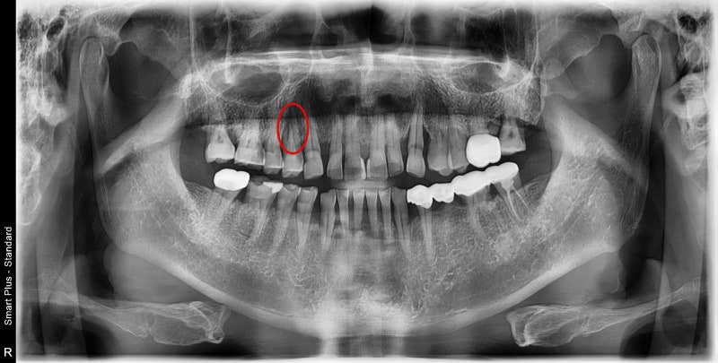 Shindang-dong Dental Clinic: Implant and Tooth Problems When Chewing Causes Pain