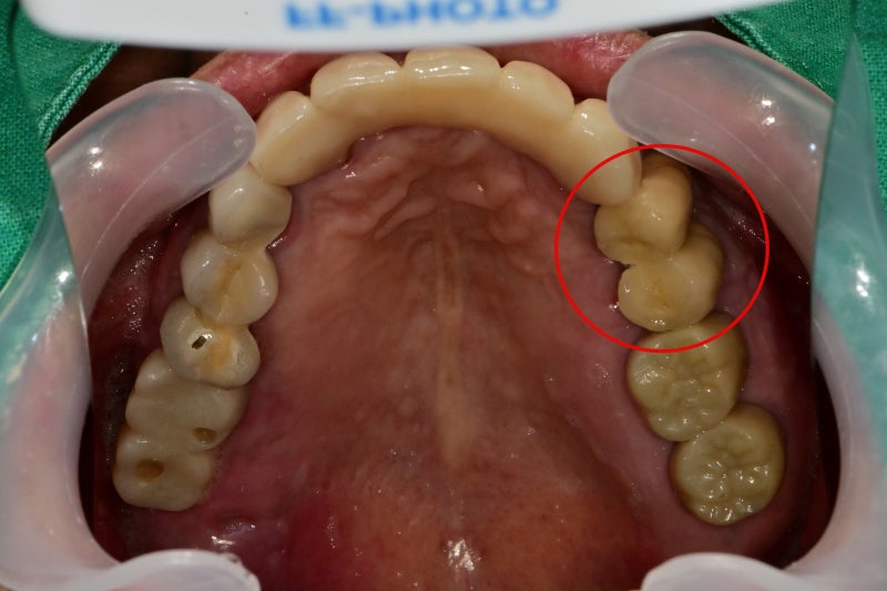 Shindang-dong Dental Clinic: Implant and Tooth Problems When Chewing Causes Pain 사진 8