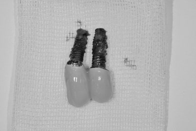 Shindang-dong Dental Clinic: Implant and Tooth Problems When Chewing Causes Pain 사진 10