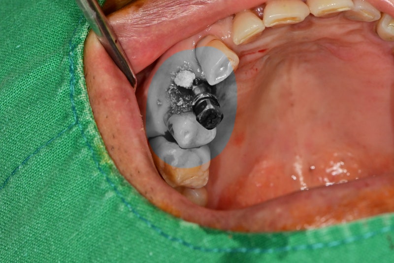 Shindang-dong Dental Clinic: Implant and Tooth Problems When Chewing Causes Pain 사진 5