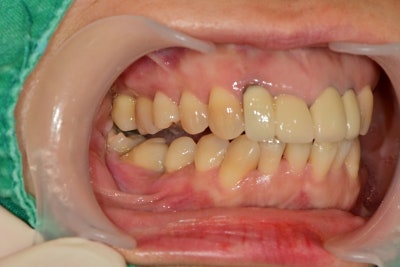 Problems Arising When Too Much Time Passes After a Tooth Extraction Near Singeumho Station Dental Clinic 사진 3