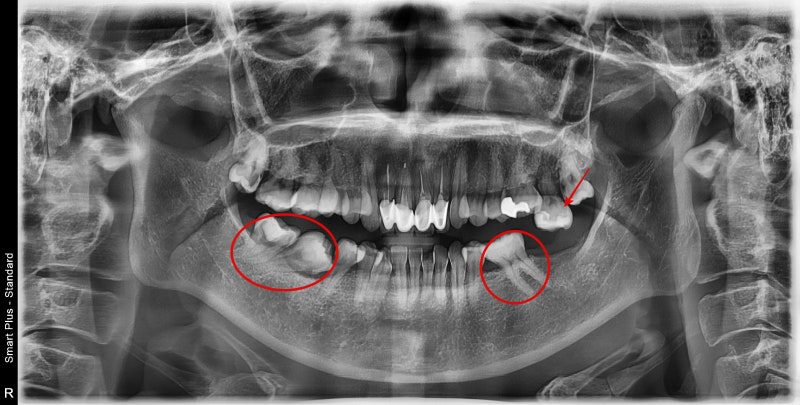 Problems Arising When Too Much Time Passes After a Tooth Extraction Near Singeumho Station Dental Clinic 사진 2