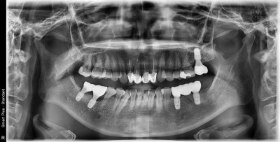 Problems Arising When Too Much Time Passes After a Tooth Extraction Near Singeumho Station Dental Clinic