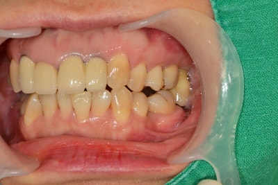 Problems Arising When Too Much Time Passes After a Tooth Extraction Near Singeumho Station Dental Clinic 사진 4