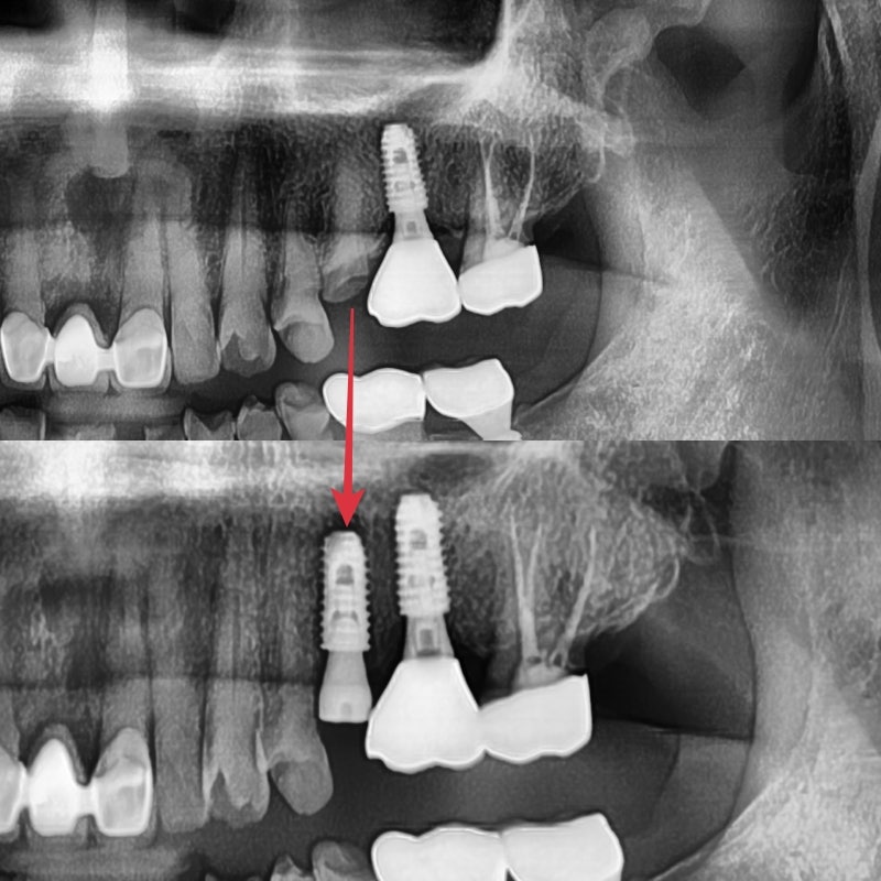 Burtigogae Station Dental Clinic: Restoring Chipped and Worn Teeth 사진 3