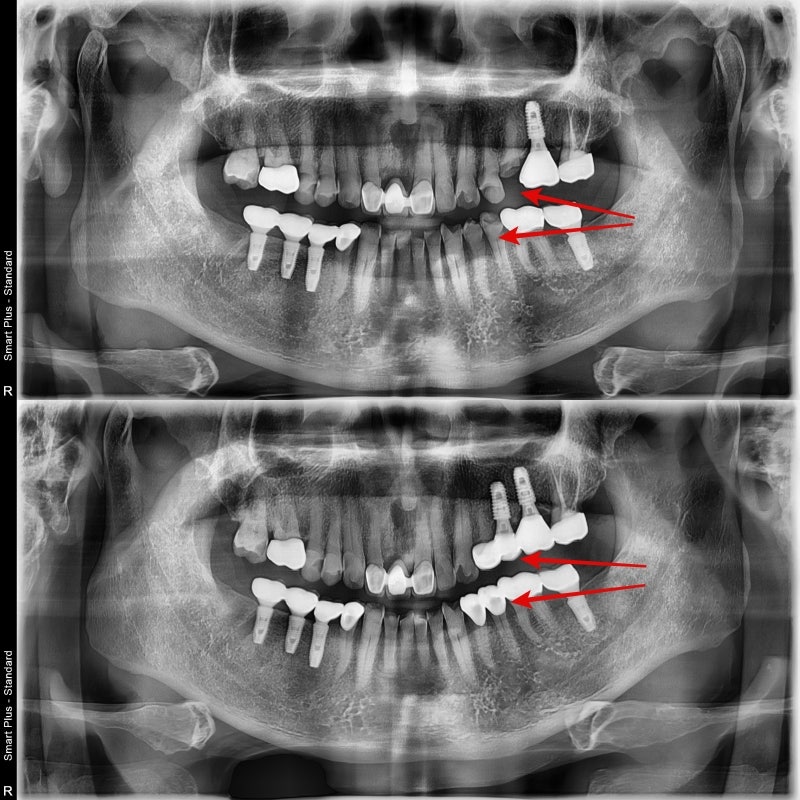 Burtigogae Station Dental Clinic: Restoring Chipped and Worn Teeth 사진 4