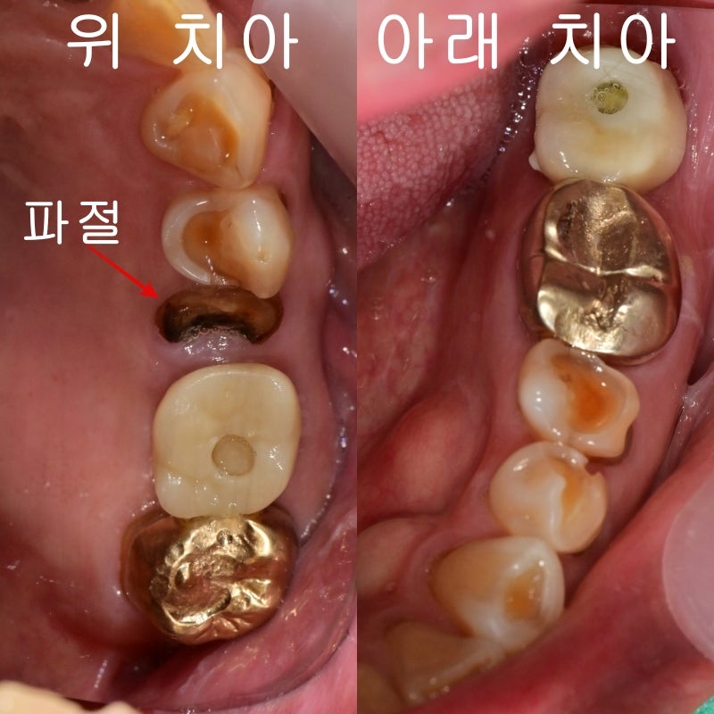 Burtigogae Station Dental Clinic: Restoring Chipped and Worn Teeth