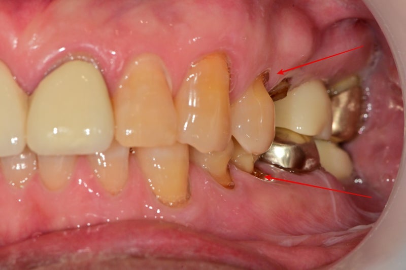 Burtigogae Station Dental Clinic: Restoring Chipped and Worn Teeth