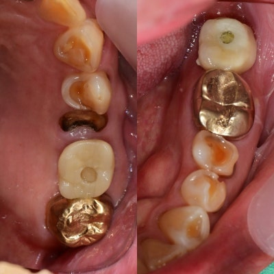 Burtigogae Station Dental Clinic: Restoring Chipped and Worn Teeth 사진 5