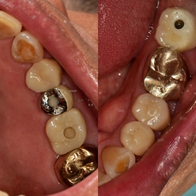 Burtigogae Station Dental Clinic: Restoring Chipped and Worn Teeth 사진 6
