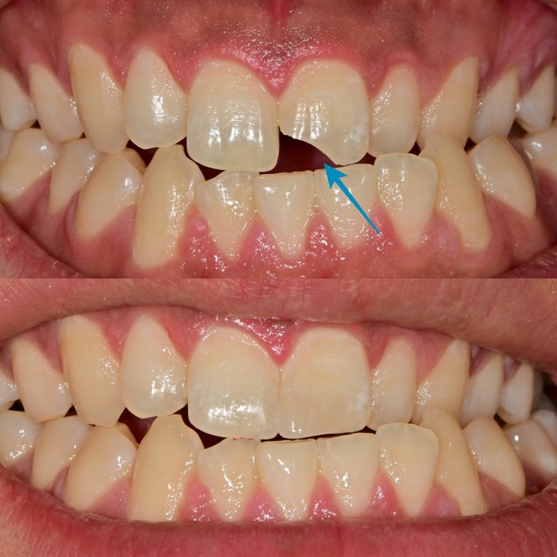 Dongdae Entrance Area Dental Clinic: Treating Broken Front Teeth Without Tooth Reduction
