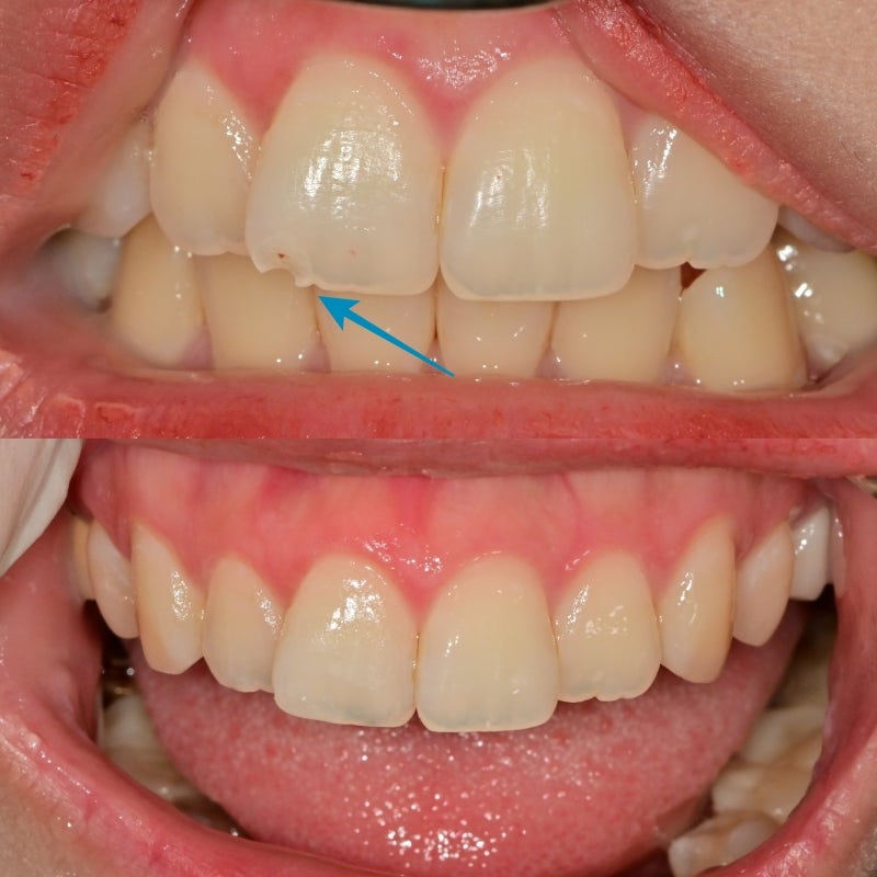 Dongdae Entrance Area Dental Clinic: Treating Broken Front Teeth Without Tooth Reduction 사진 3