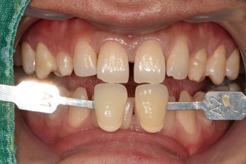 Why Front Tooth Laminates are Done at Cheonggu-dong Dental Clinic 사진 3