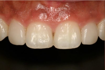 Why Front Tooth Laminates are Done at Cheonggu-dong Dental Clinic 사진 2