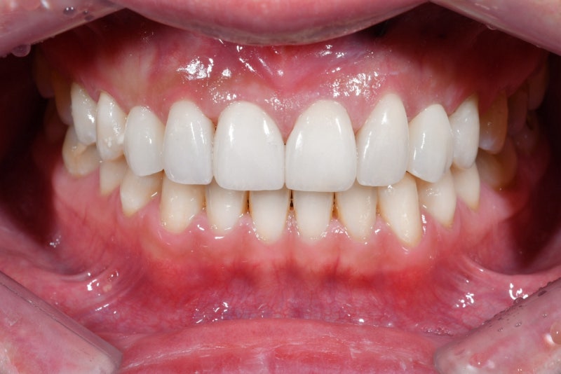 Why Front Tooth Laminates are Done at Cheonggu-dong Dental Clinic 사진 8